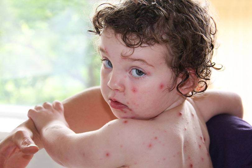 همه چیز درباره ی آبله مرغان