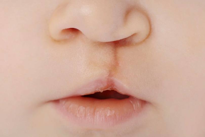 چالش های مادران با نوزادان دارای شکاف کام(لب شکری)